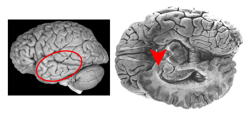 Disse to bildene viser menneskehjernen. Området som kalles amygdala er markert med sirkel og pil. Data fra amygdala ligner på data som NTNU-forskerne har funnet i nattsvermerens laterale horn. (Illustrasjon: NTNU)