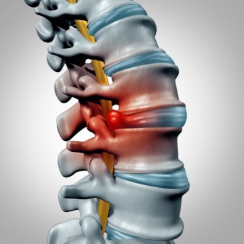 If you have a slipped disc, it means that one of the discs that act as cushions between each vertebra has been damaged. Illustration: Thinkstock
