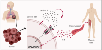 How cancer breaks down your muscles