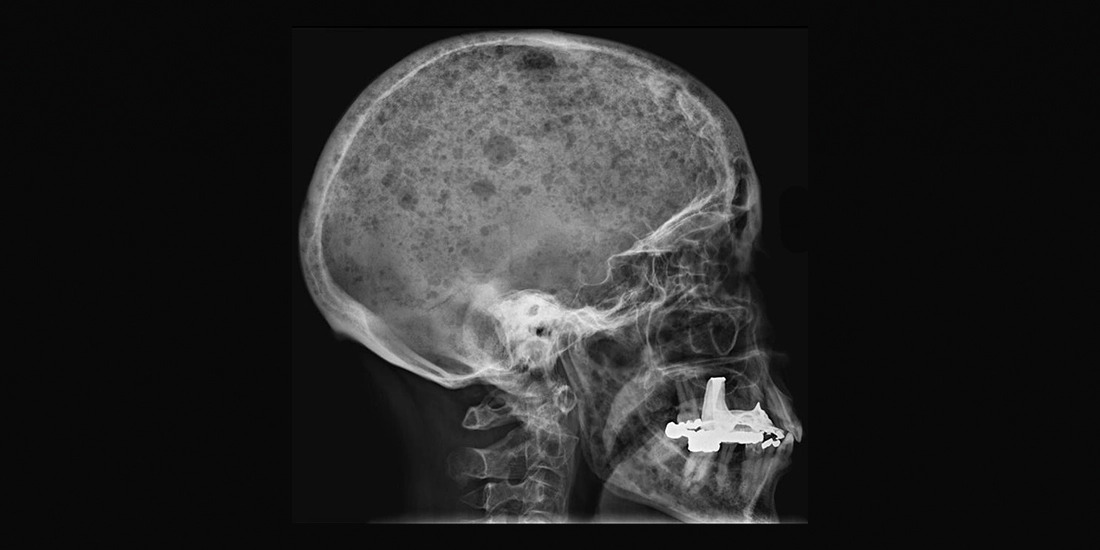 An x-ray of a skull with holes