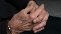 hands deformed by arthritus