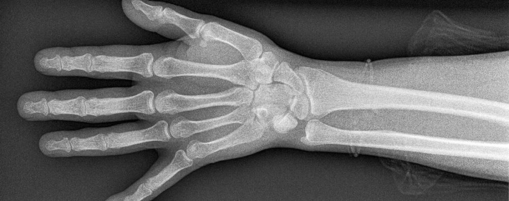 X-Ray of hand and wrist
