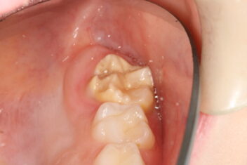 Six year molars with hypomineralization