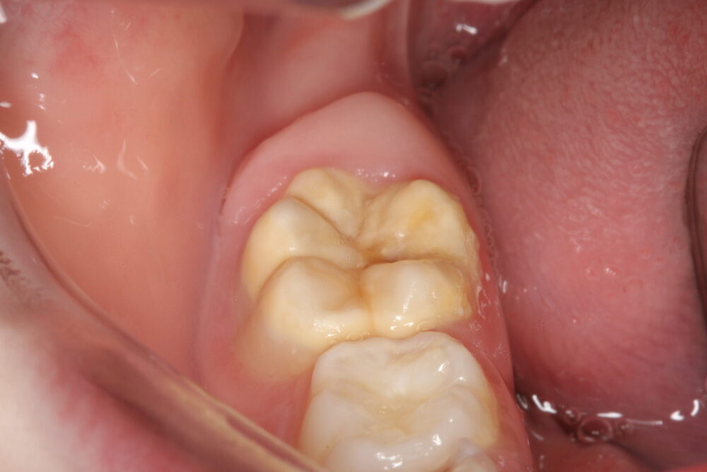 Six year molars which are discoloured but not damaged