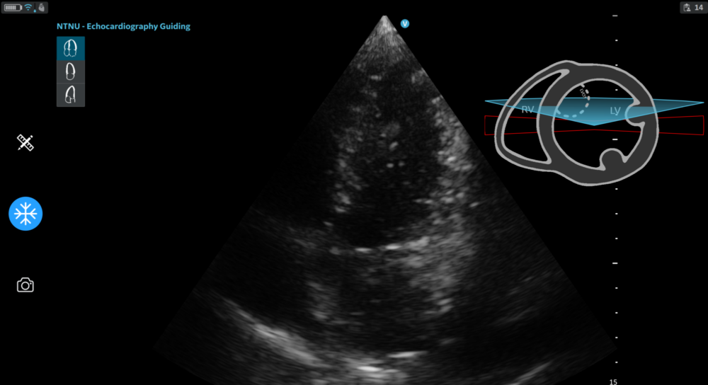 Ultrasound screen image with an AI tool that shows how the probe should be positioned