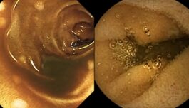 AI helping doctors to detect intestinal disease