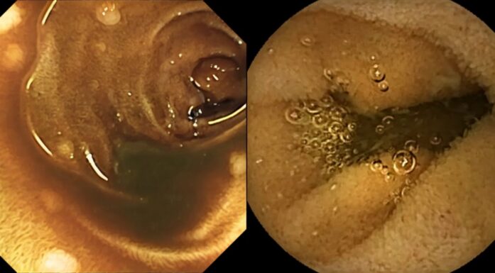 An AI-generated and a real image of polyps.