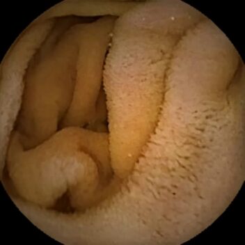 A photo from inside an intestine.