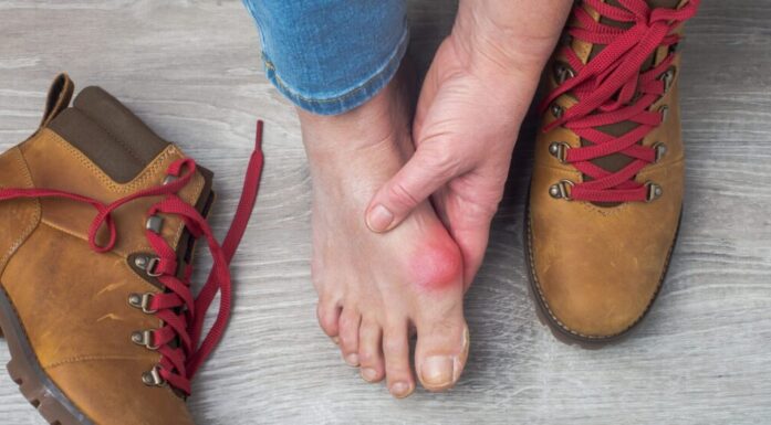 Feet of bunion sufferer outside of boots