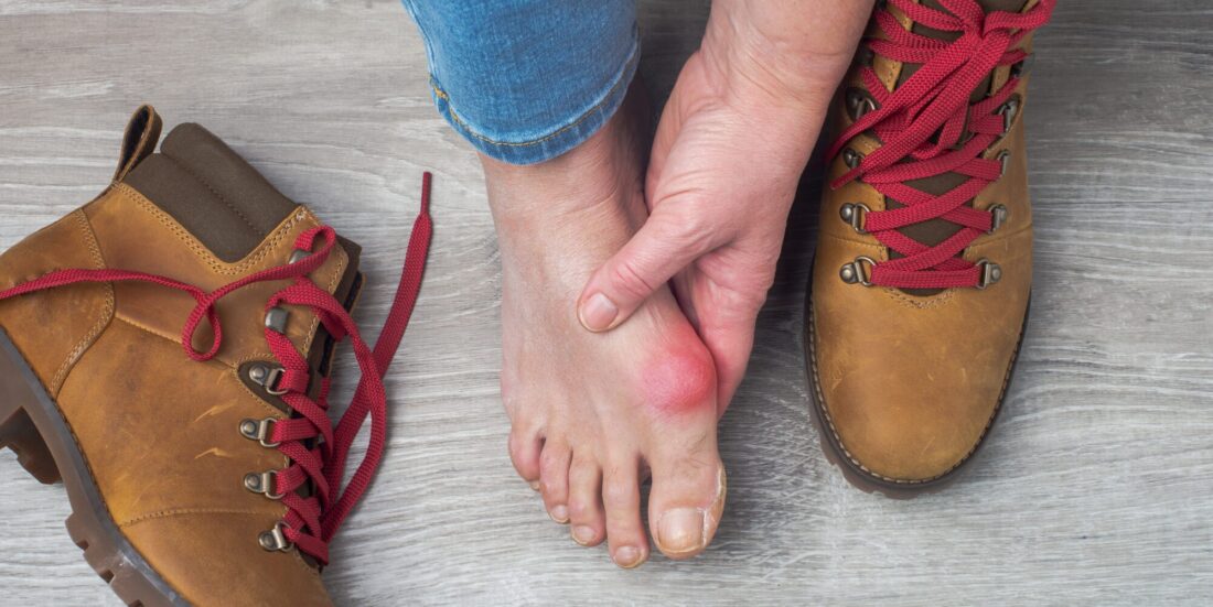Feet of bunion sufferer outside of boots