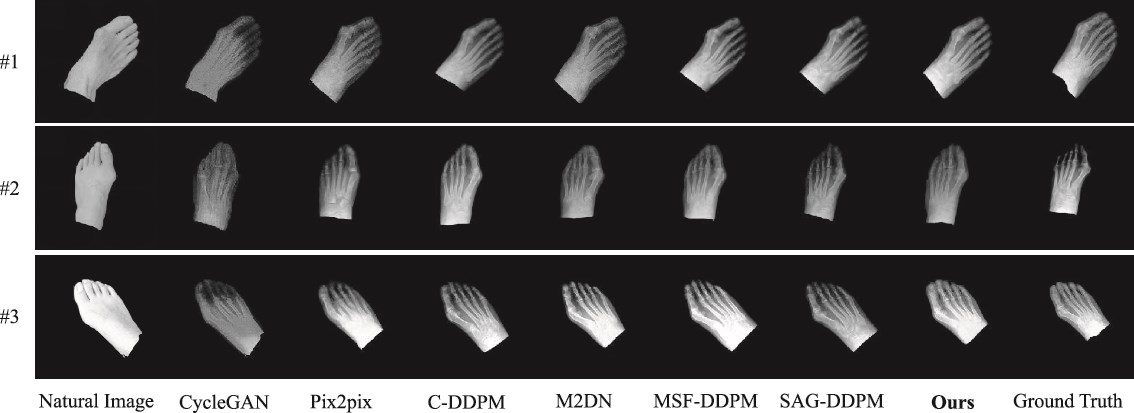 black and white image of feet at various stages of hallux valgus