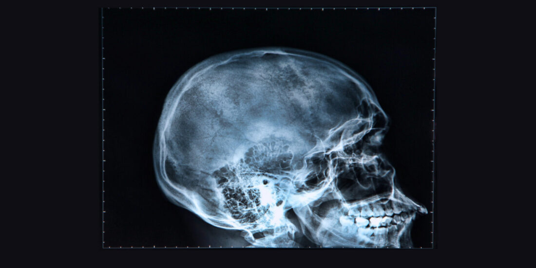 x-ray of a skull