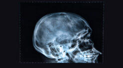 x-ray of a skull