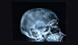 Body data could provide a 24-hour warning for headaches